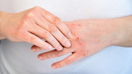 6 cách kiểm soát tình trạng ngứa da