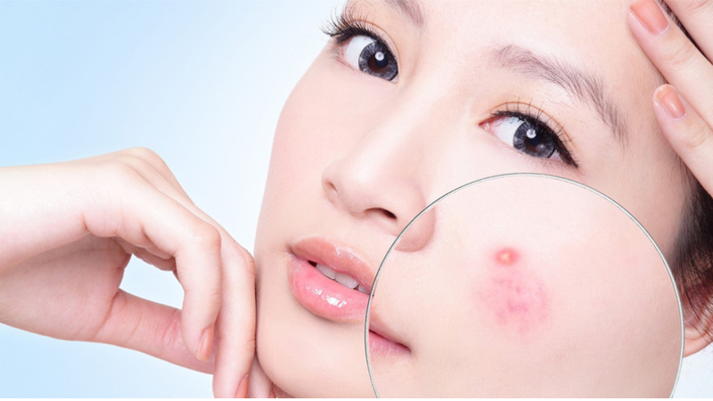 Hỗ trợ điều trị mụn cũng là tác dụng của HA
