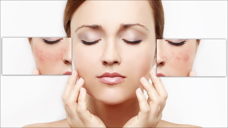 Hỗ trợ điều trị mụn cũng là tác dụng của HA