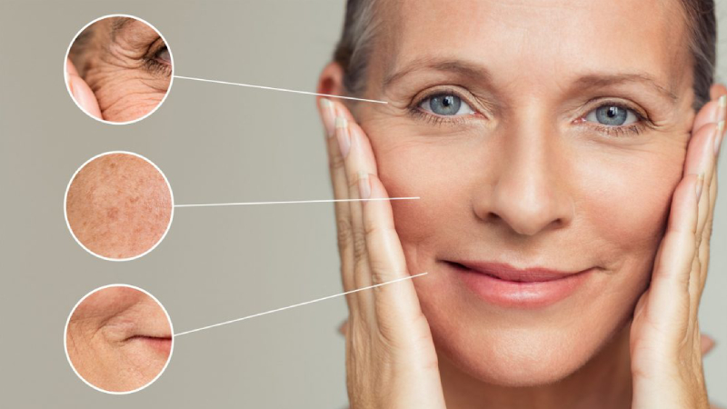 Nhiều phụ nữ trung niên lựa chọn acid hyaluronic để cải thiện vết chân chim