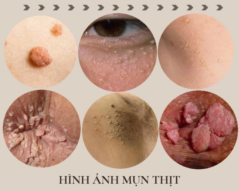 Nguyên nhân gây mụn thịt ở mắt. Top 3 mẹo chữa mụn thịt tại nhà mà bạn nên biết 1