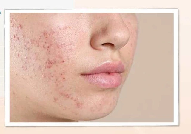 Thay da sinh học và cách chăm sóc sau khi 'lột, tẩy' da- Ảnh 4. Thay da sinh học và cách chăm sóc sau khi 'lột, tẩy' da- Ảnh 4.