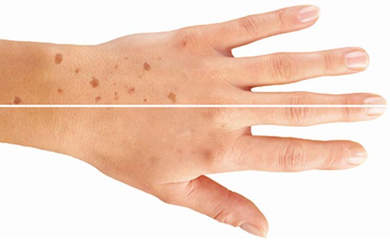 Cách đơn giản xóa đốm đồi mồi trên da tại nhà - Ảnh 2. Cách đơn giản xóa đốm đồi mồi trên da tại nhà - Ảnh 2.