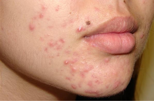 Mụn bọc được hình thành do nhiều nguyên nhân