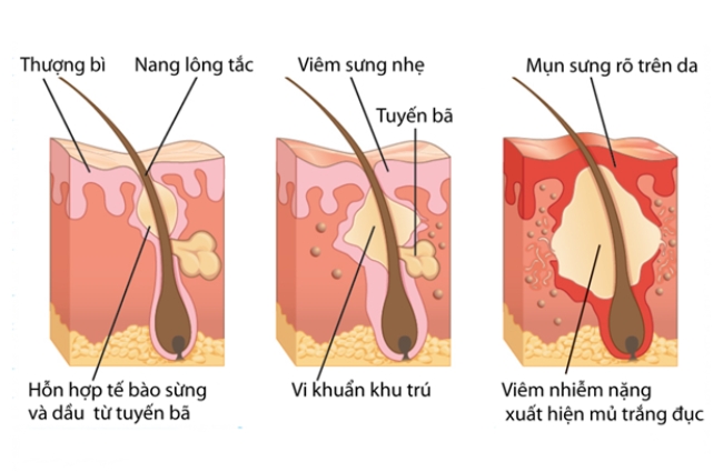 Các giai đoạn tiến triển của mụn bọc
