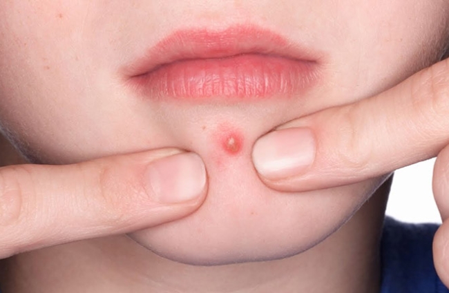 Dùng tay nặn mụn tiềm ẩn nguy cơ gây viêm nhiễm và sẹo thâm