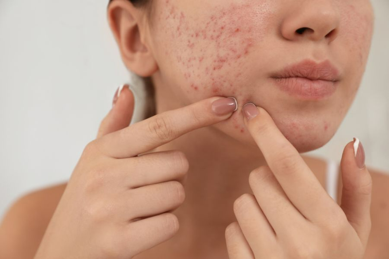 Da bị vết thâm mụn mãi không hết phải làm sao?2