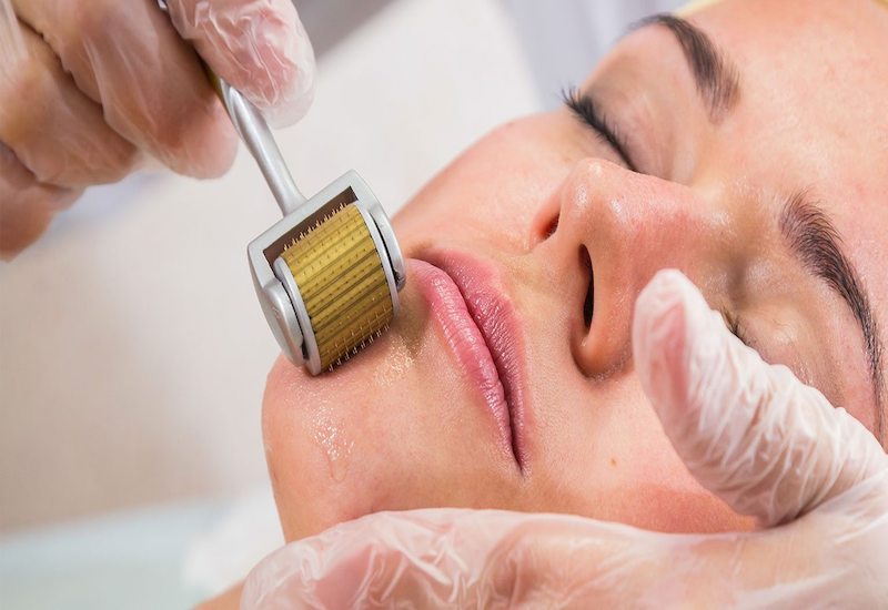 Bật mí những cách trị sẹo mụn hiệu quả nhất 4