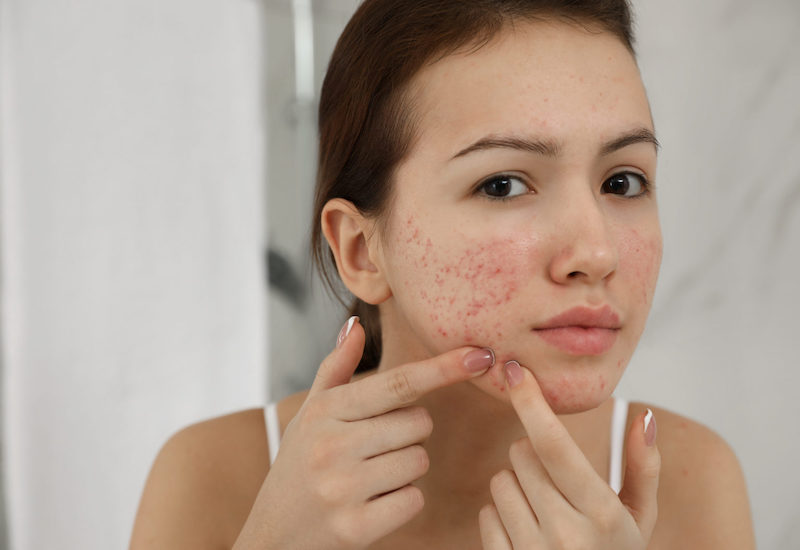 Bật mí những cách trị sẹo mụn hiệu quả nhất 1