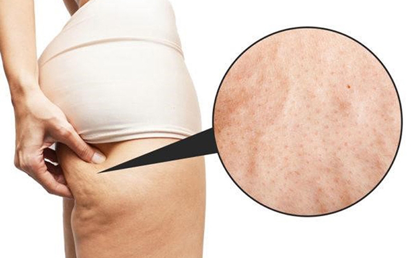 Da sần vỏ cam: Nguyên nhân và cách khắc phục 1