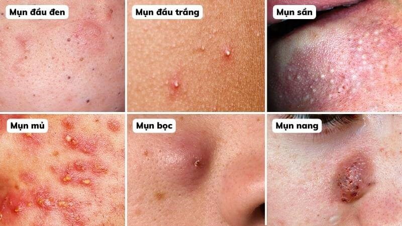 Có 6 loại mụn trứng cá thường gặp