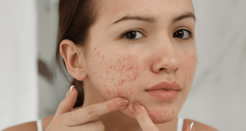 Góc giải đáp thắc mắc: Sẹo mụn có tự hết không? 3