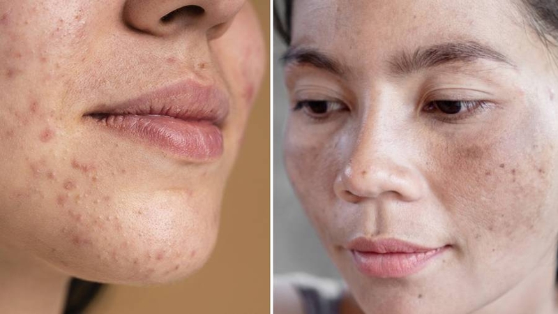 Da xỉn màu là gì? Nguyên nhân và cách khắc phục làn da xỉn màu 1