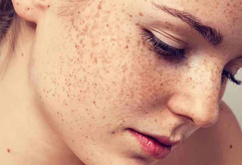 Rối loạn sắc tố melanin và những điều bạn nên biết 1