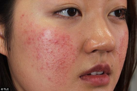 mụn trứng cá