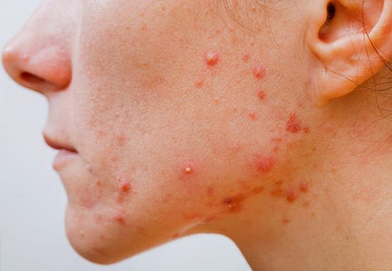 Cách trị mụn viêm đỏ không nhân tại nhà nhanh chóng 1